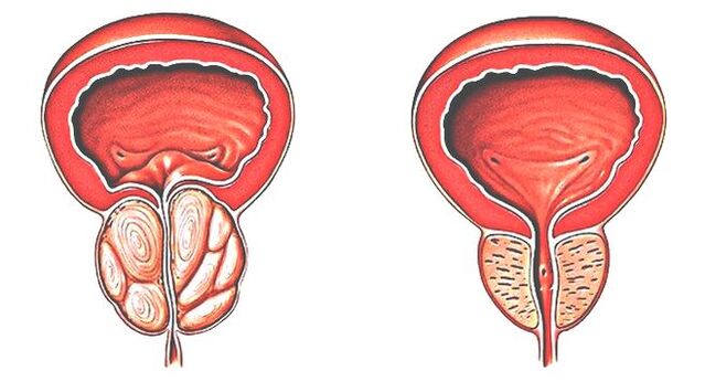 Prostatita si prostata normala