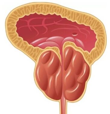 Inflamarea prostatei