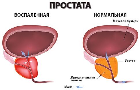 prostată