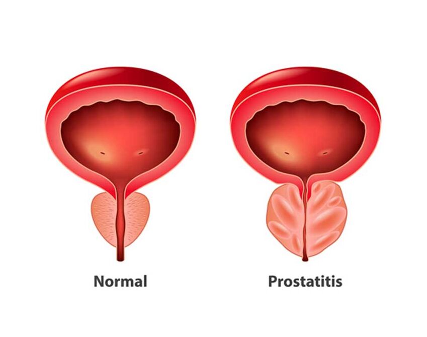 prostată normală și inflamatorie