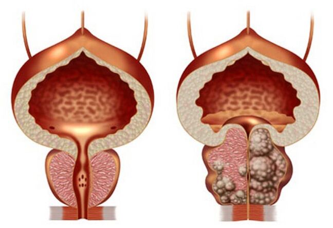 prostată sănătoasă și adenom de prostată